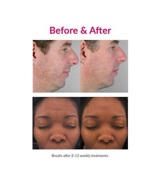 PMD Персональная микродерма Pro Blush Microdermabrasion 1 ПК. 80033068-C-80033068-1 фото